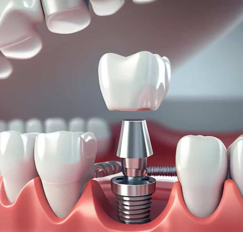 Dental Implants